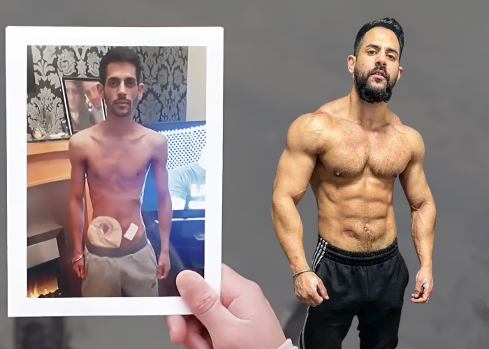Manny now standing next to a photo of him when he had crohns disease