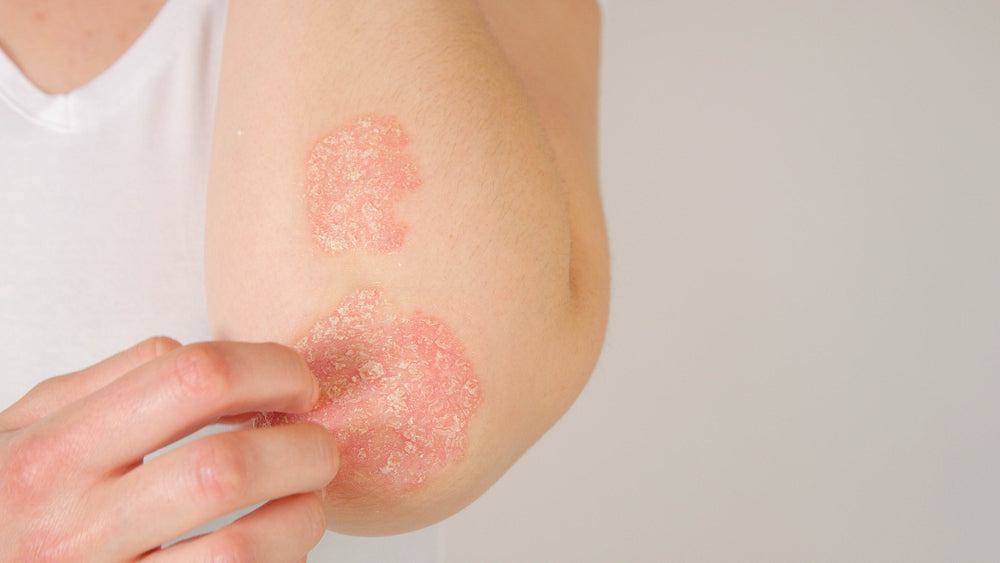 gut-skin axis - Unrecognizable young woman suffering from autoimmune dermatological skin disease called psoriasis. Female gently scratching red, inflamed, scaly rash on elbows